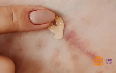 روش های موثر و خانگی برای درمان سریع زخم تازه صورت
